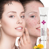 RtopR Mango Acne Treatment Moisturizing Cream